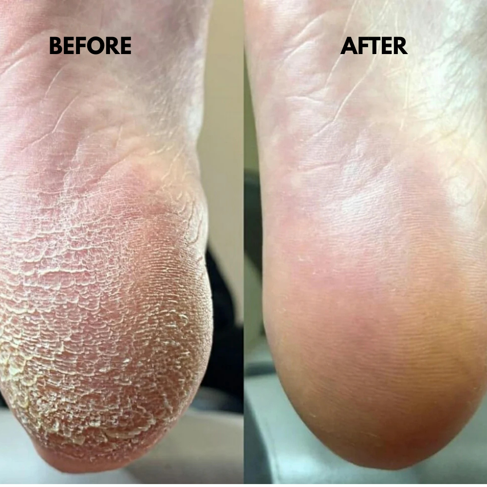 ZYNALLA™ Anti Cracked Foot Cream
