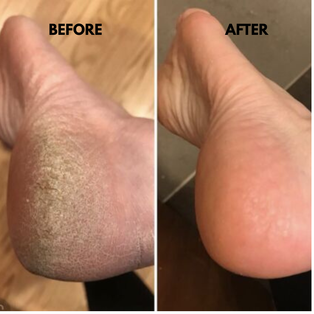 ZYNALLA™ Anti Cracked Foot Cream
